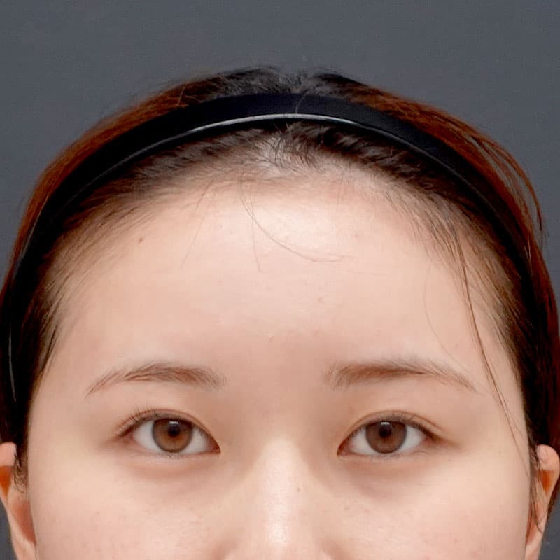 20251017_St20251017-tanaka_hyaluronic forehead①After