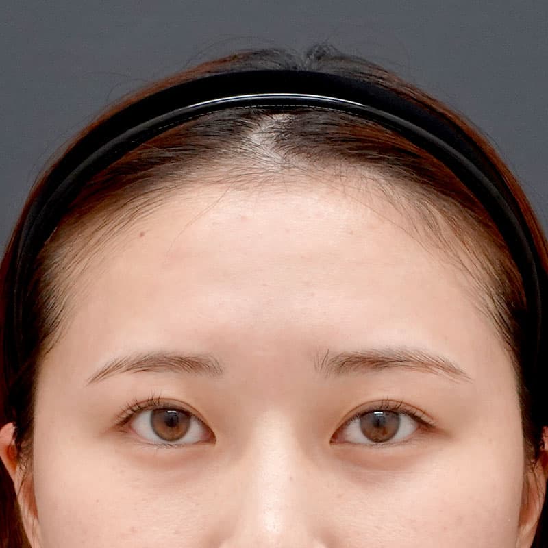 20251017_St20251017-tanaka_hyaluronic forehead①Before