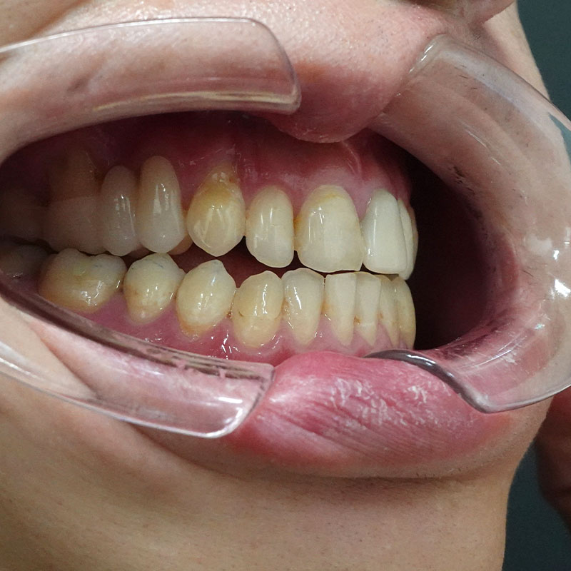 202510_nishida_Mandibular ramus sagittal division①After