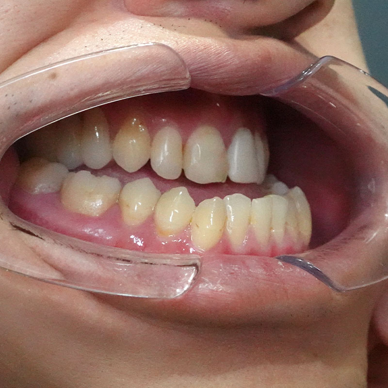 202510_nishida_Mandibular ramus sagittal division①Before