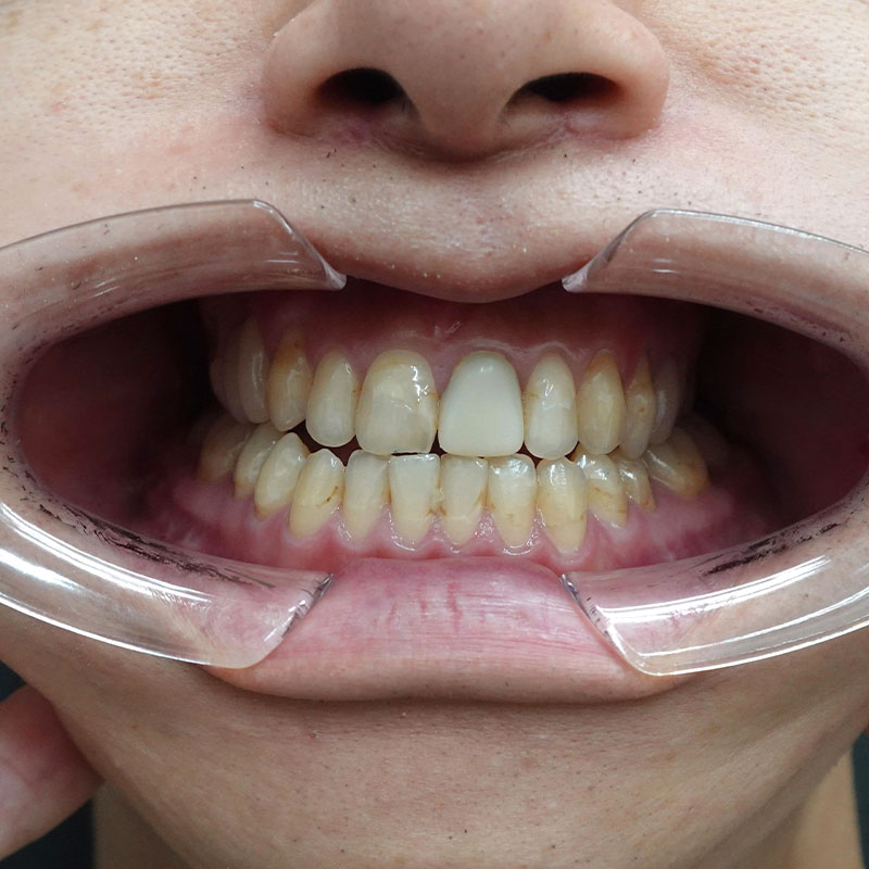 202510_nishida_Mandibular ramus sagittal division②After