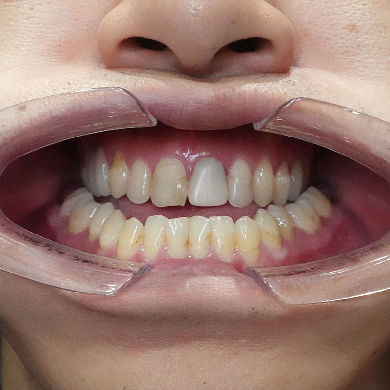 202510_nishida_Mandibular ramus sagittal division②Before