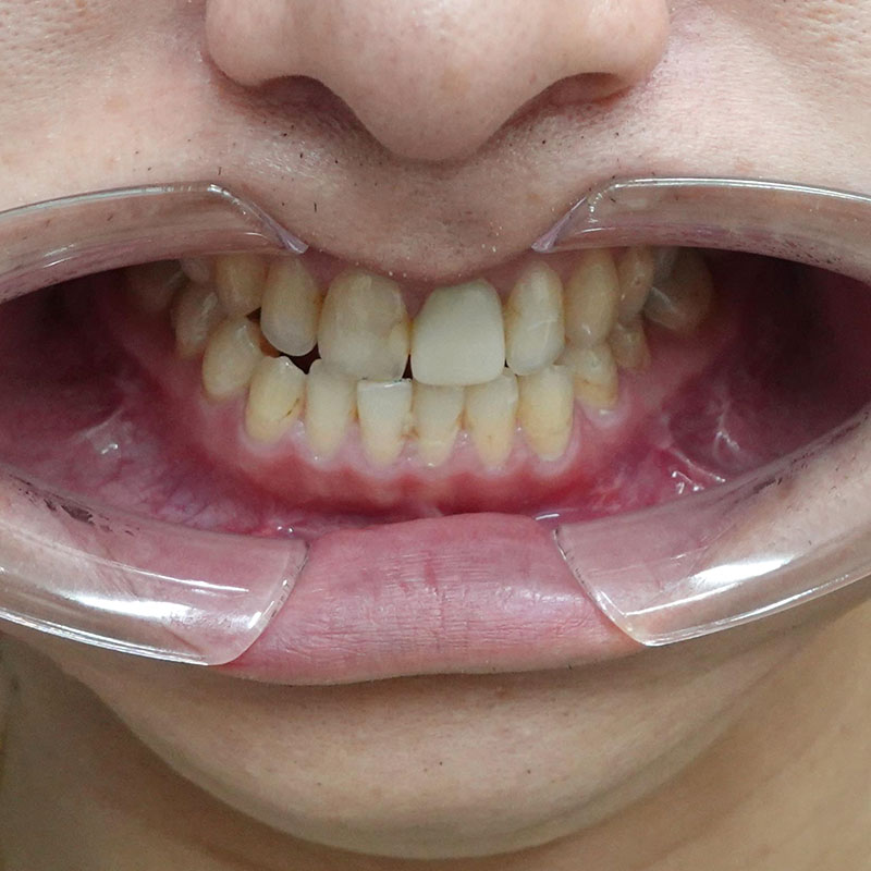 202510_nishida_Mandibular ramus sagittal division③After