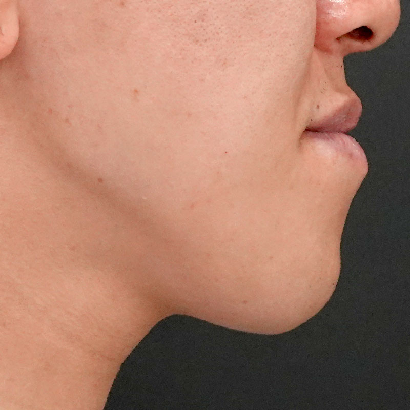 20251102_G127067_nishida_Mental formation -1③Before_2