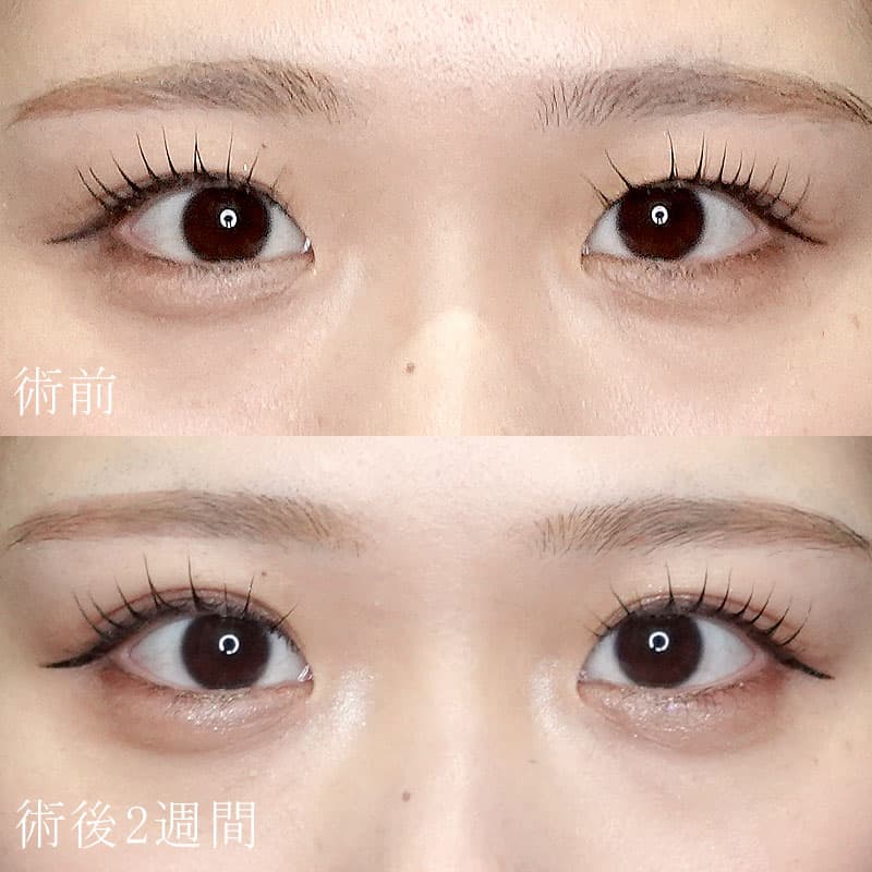 20251031_G148924_sugiyama_double-burial-method hyaluronic eye bagsメイン横