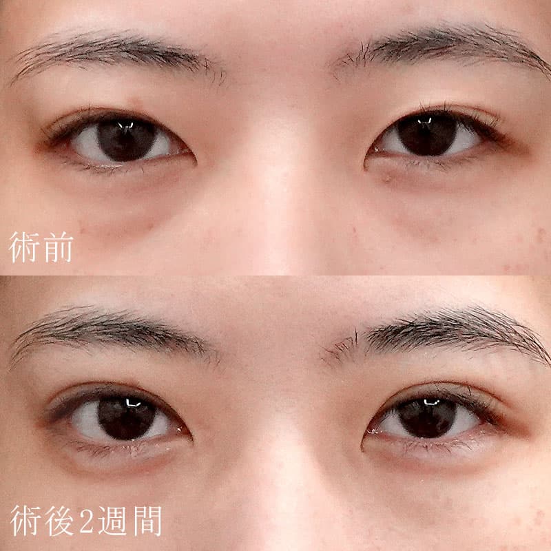 20251031_S132458_koito_double-burial-method hyaluronic eye bagsメイン横