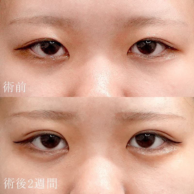 20251031_S136449_koito_double-burial-method hyaluronic eye bagsメイン横