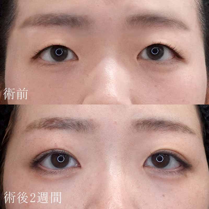 20251101_F148623_kadoya_double-burial-method_hyaluronic acid tear bagメイン横