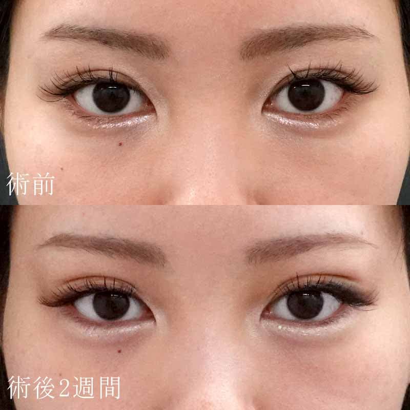 20251101_F7138_kadoya_double-burial-method_hyaluronic acid tear bagメイン横