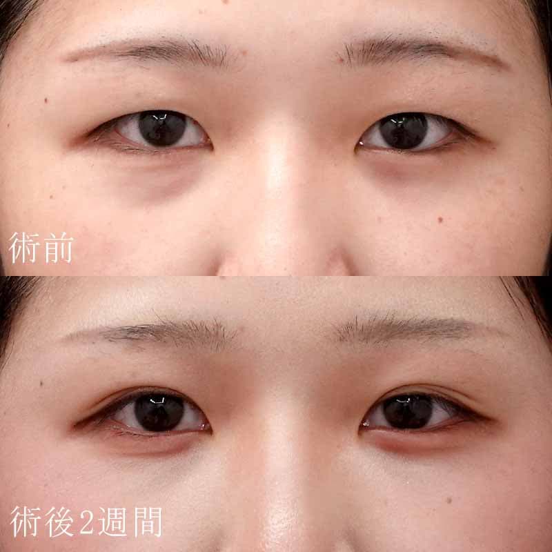 20251101_S149813_tokiwa_double-burial-method_hyaluronic acid tear bagメイン横