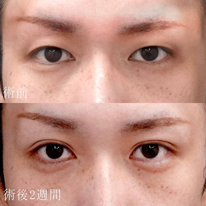 20251101_S150800_tokiwa_double-burial-method_hyaluronic acid tear bagメイン横