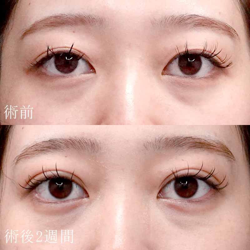 20251101_S1559801_tokiwa_double-burial-method_hyaluronic acid tear bagメイン横