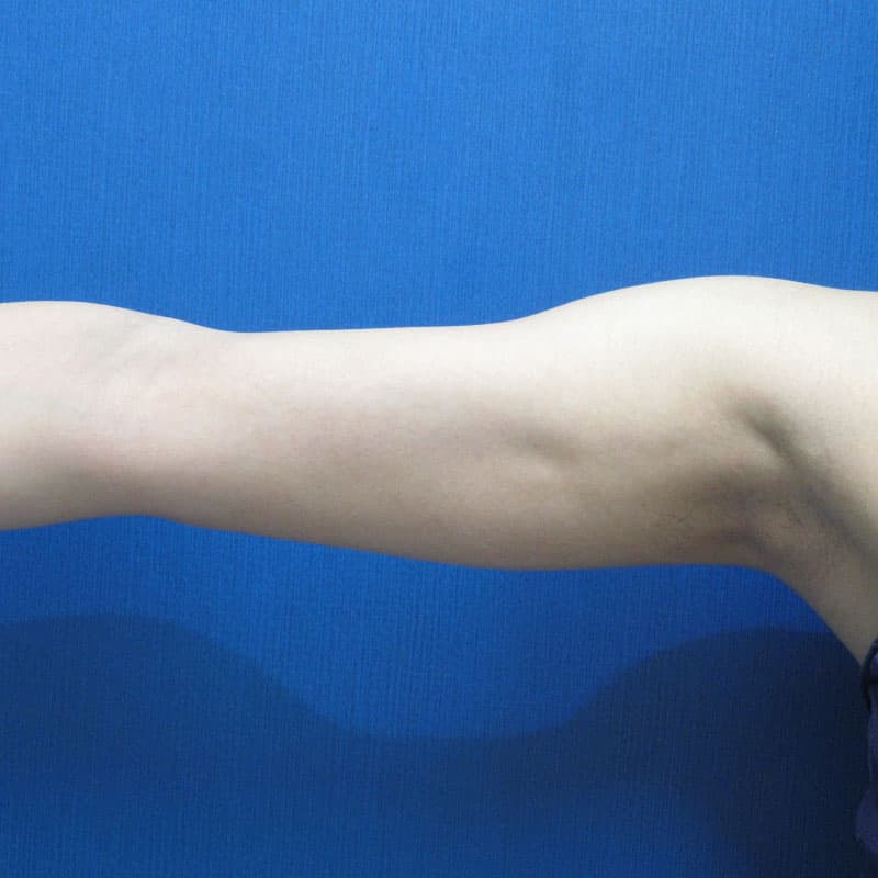 20251115_G22226_furumura_arm-liposuction①After