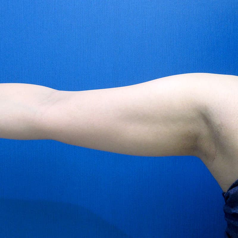 20251115_G22226_furumura_arm-liposuction①Before