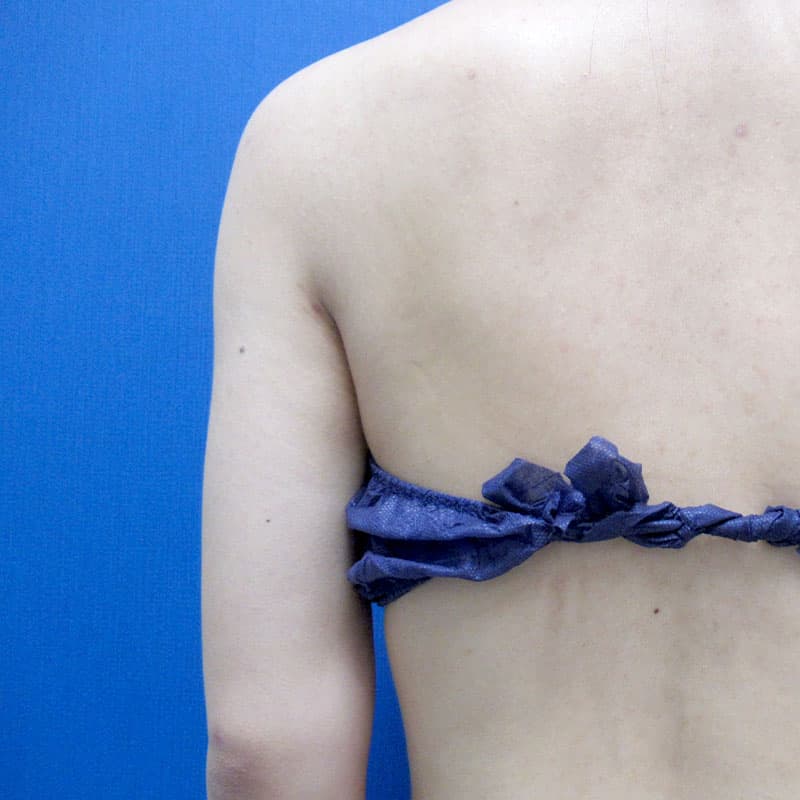 20251115_G2226_furumura_arm-liposuction①After