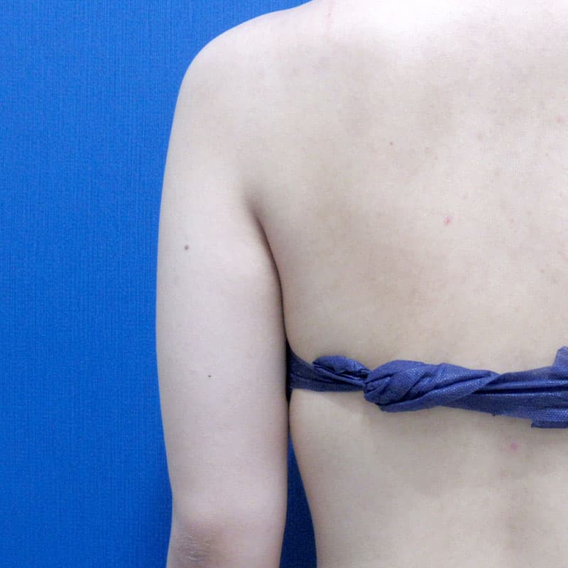 20251115_G2226_furumura_arm-liposuction①Before