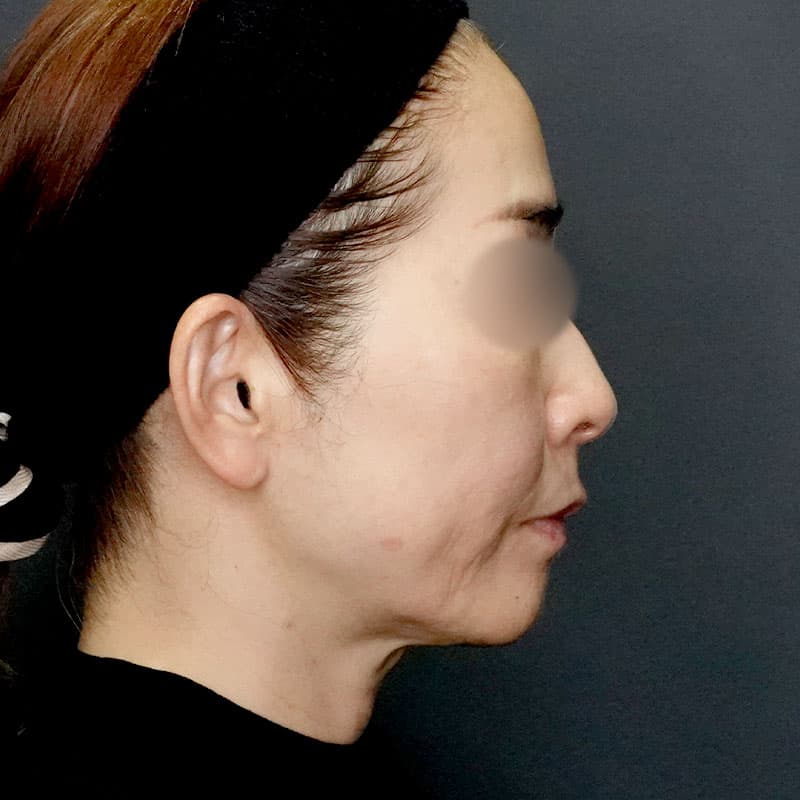 20251115_S107605_volnewmer②Before