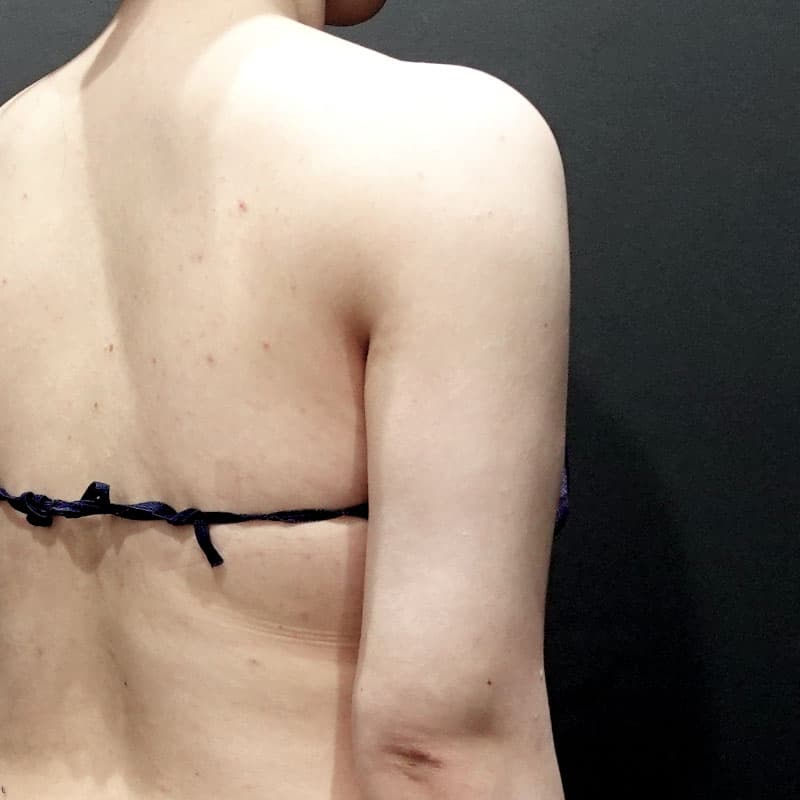 20251115_St20251115-1_osada_arm-liposuction①After