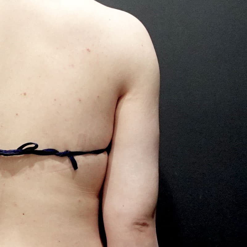 20251115_St20251115-1_osada_arm-liposuction②After