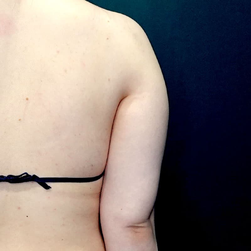 20251115_St20251115-1_osada_arm-liposuction②Before