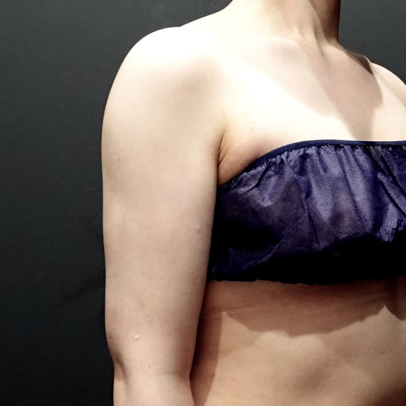 20251115_St20251115-1_osada_arm-liposuction③After