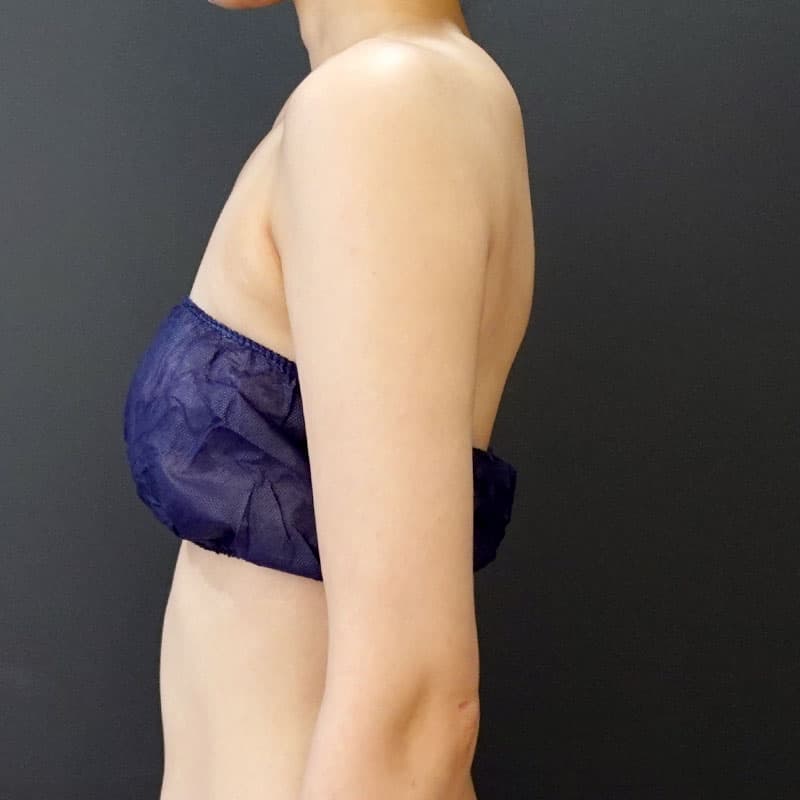 20251115_St20251115-2_osada_arm-liposuction①After