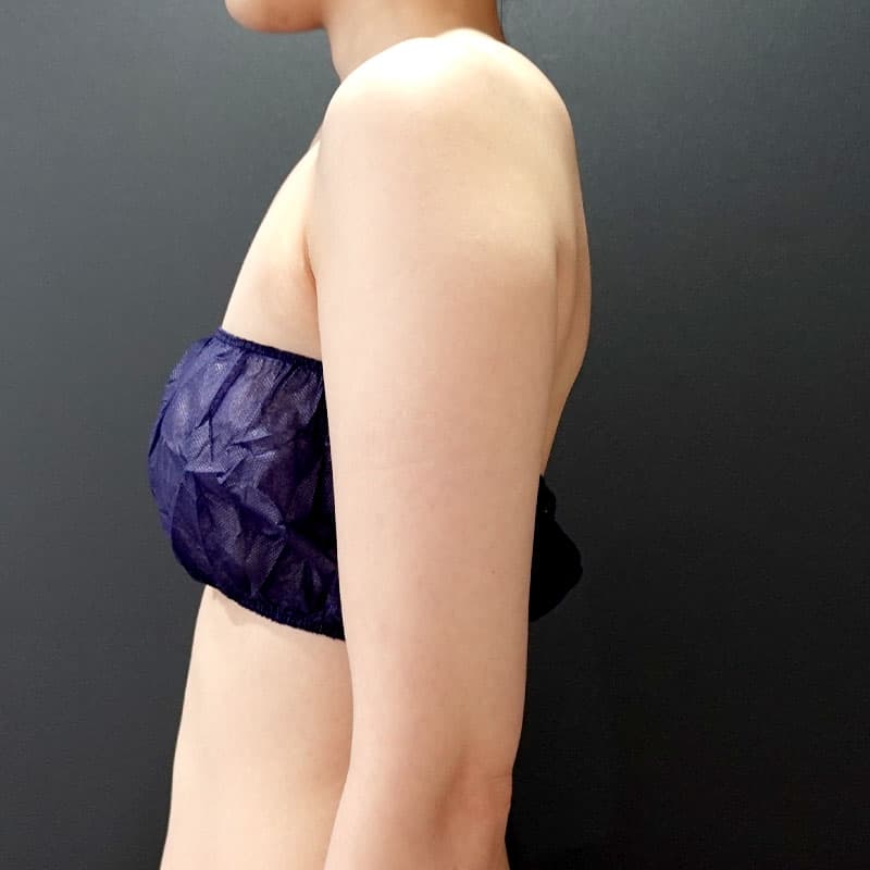 20251115_St20251115-2_osada_arm-liposuction①Before