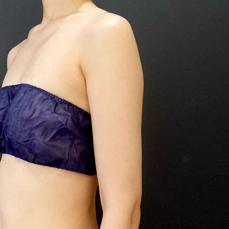 20251115_St20251115-2_osada_arm-liposuction②After