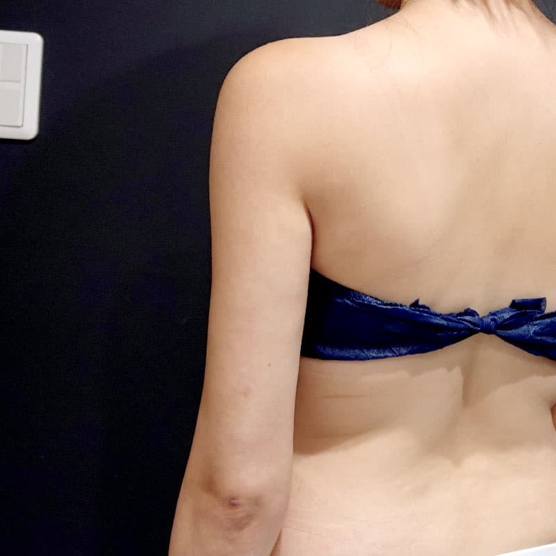 20251115_St20251115-3_osada_arm-liposuction①After