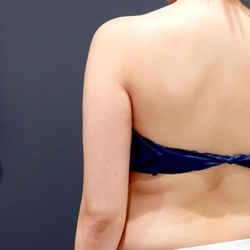 20251115_St20251115-3_osada_arm-liposuction①Before