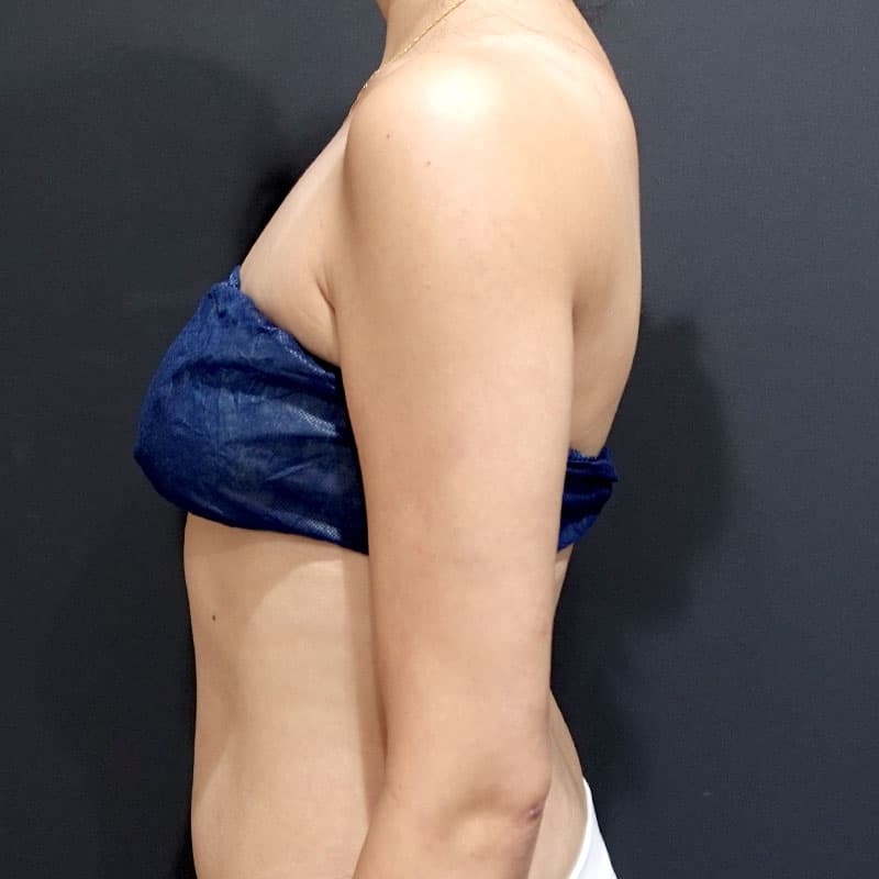 20251115_St20251115-3_osada_arm-liposuction②After