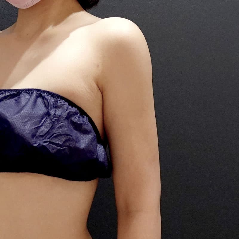 20251115_St20251115-4_osada_arm-liposuction①After