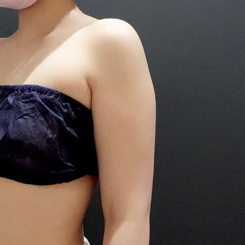 20251115_St20251115-4_osada_arm-liposuction①Before