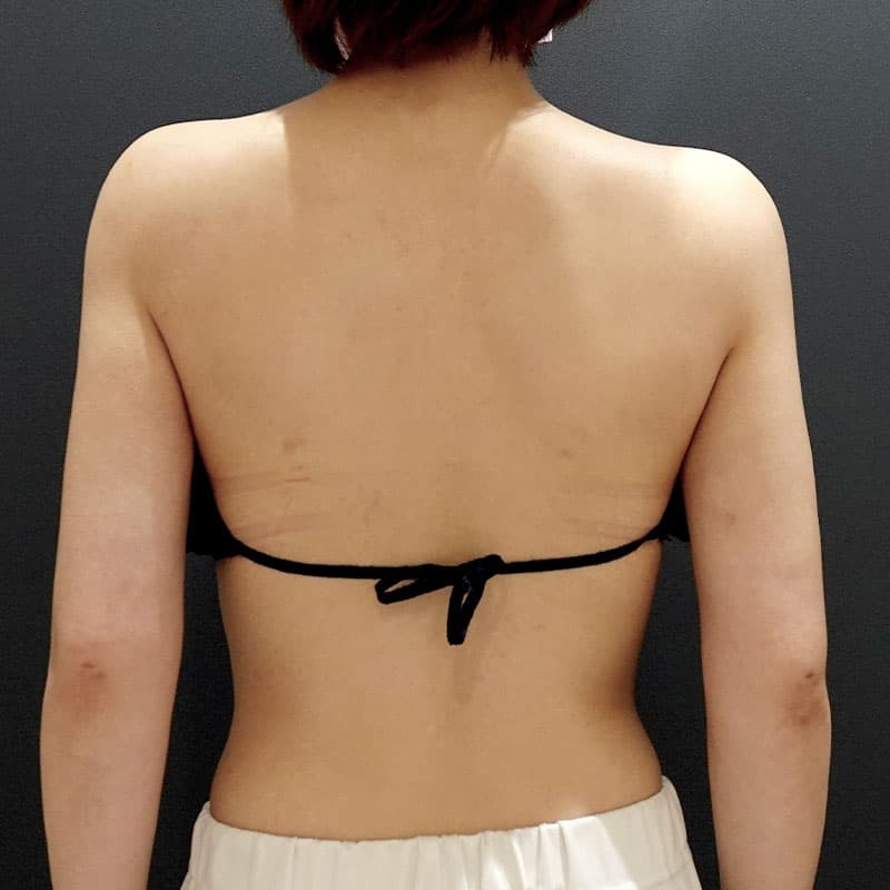 20251115_St20251115-4_osada_arm-liposuction②After