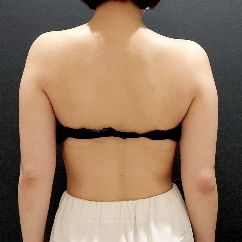 20251115_St20251115-4_osada_arm-liposuction②Before