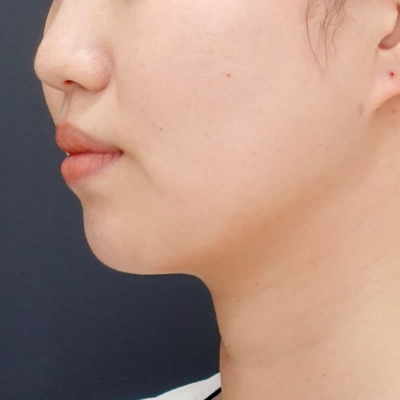 20251115_St20251115_osada_face-liposuction①After