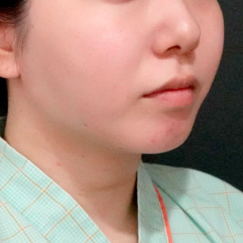 20251117_O32377_sato_face-liposuction_masseter-muscle-botox①After