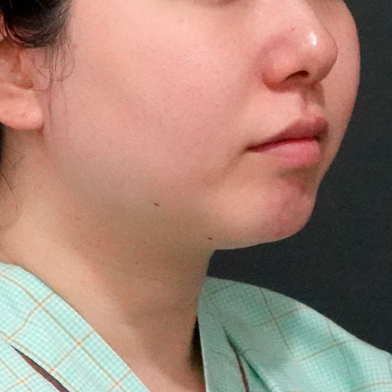 20251117_O32377_sato_face-liposuction_masseter-muscle-botox①Before
