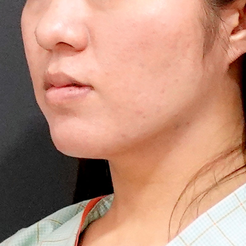 20251117_O34858_sato_face-liposuction_masseter-muscle-botox①After