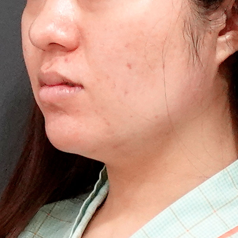 20251117_O34858_sato_face-liposuction_masseter-muscle-botox①Before