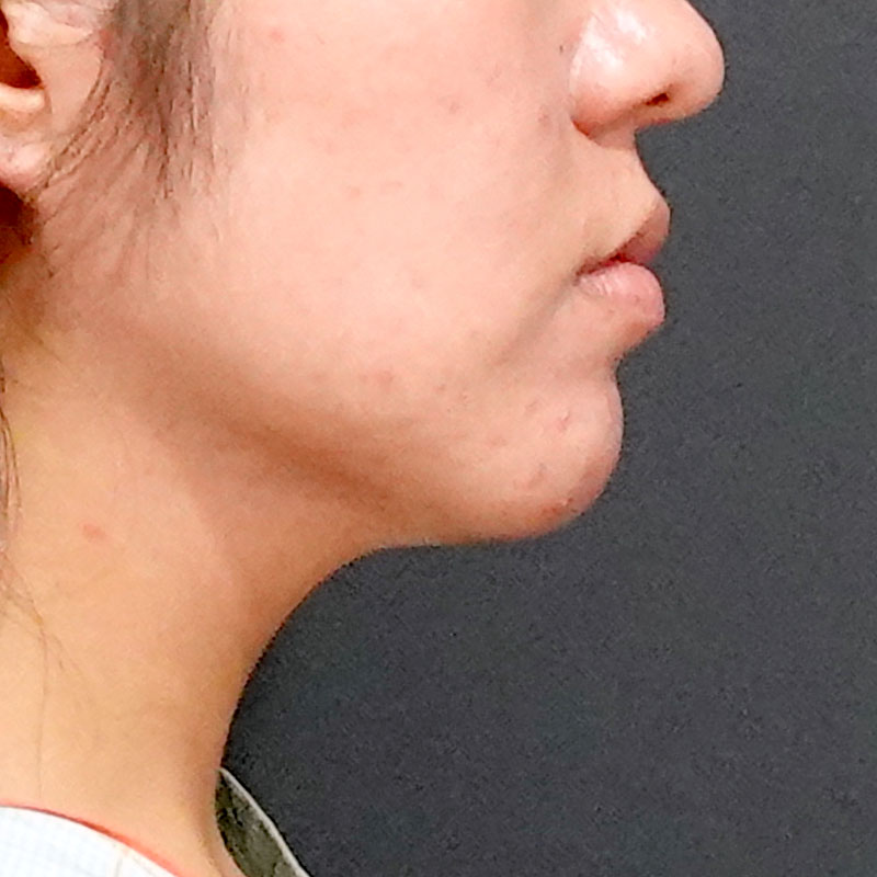 20251117_O34858_sato_face-liposuction_masseter-muscle-botox②After