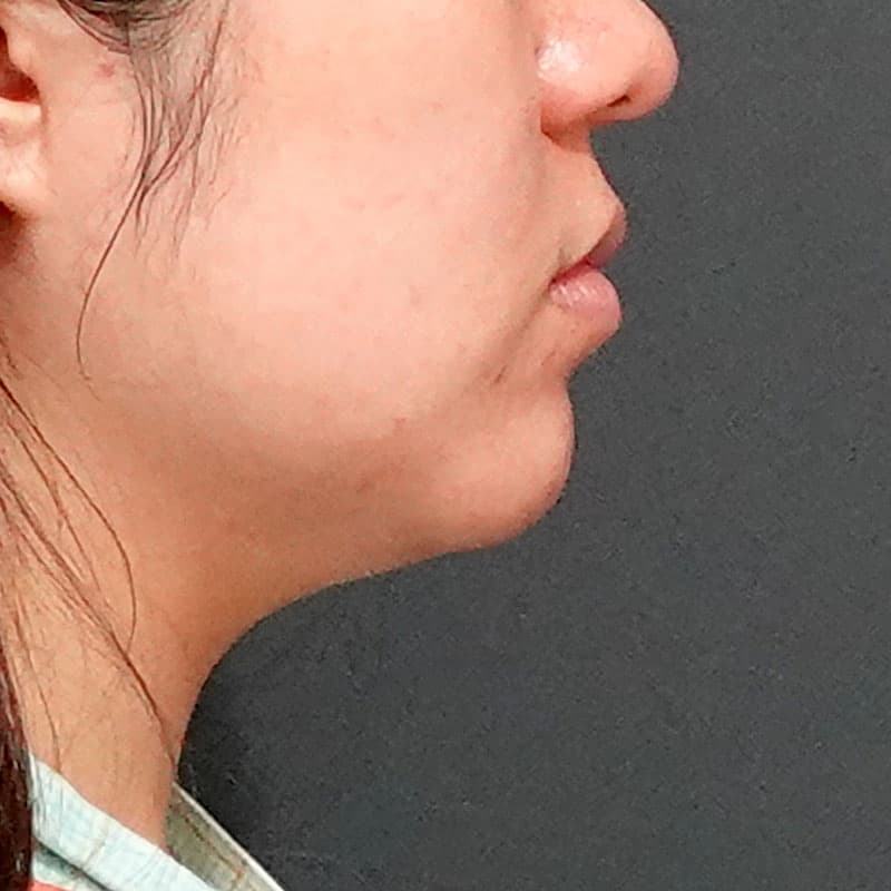 20251117_O34858_sato_face-liposuction_masseter-muscle-botox②Before