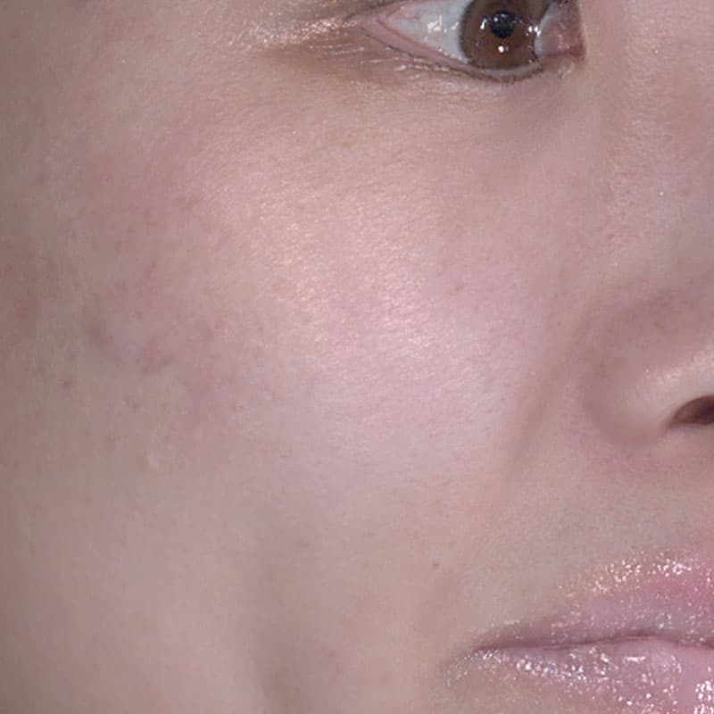 20251122_20251122-4_fukuda_micro botox①After