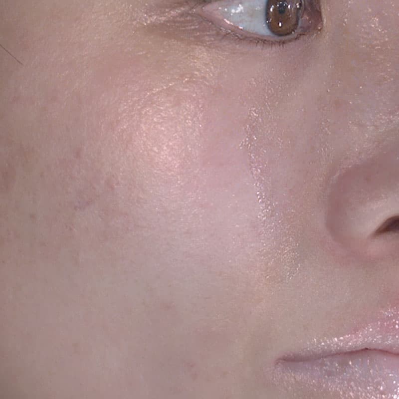 20251122_20251122-4_fukuda_micro botox①Before