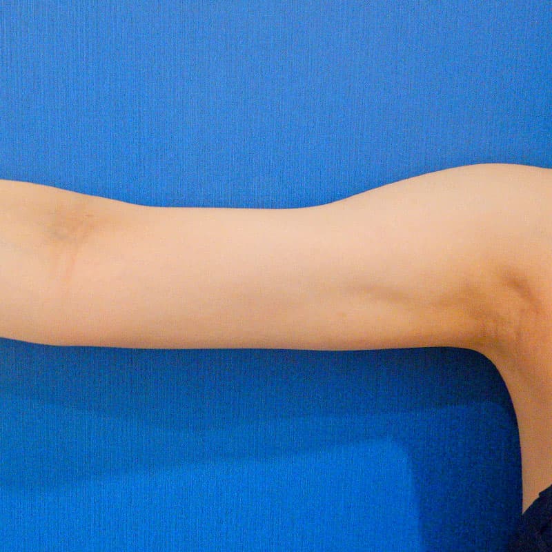 20251122_O21394_furumura_arm-liposuction①After