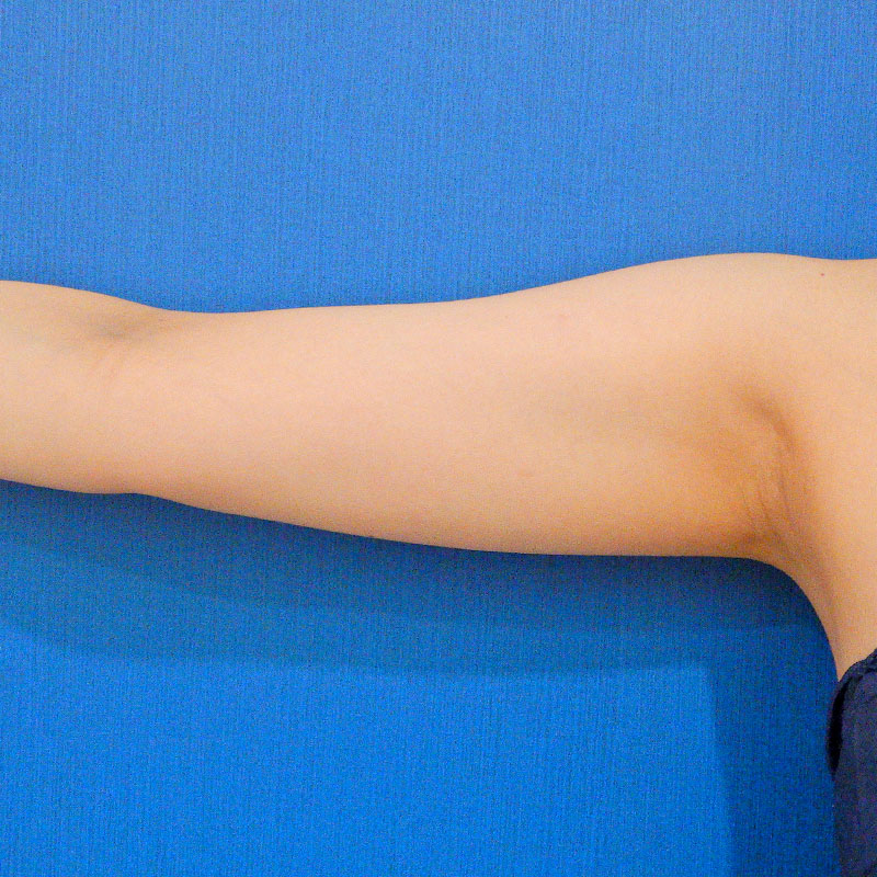 20251122_O21394_furumura_arm-liposuction①Before