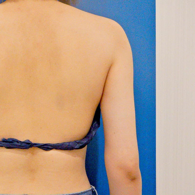 20251122_O21394_furumura_arm-liposuction②After