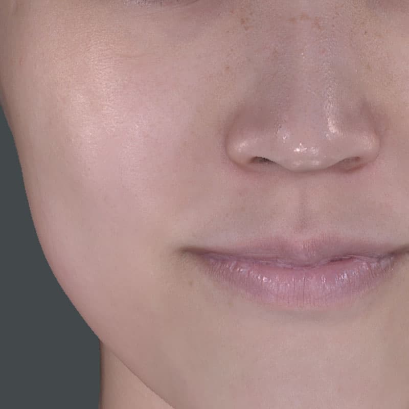 20251122_St20251122-3_fukuda_micro botox①After