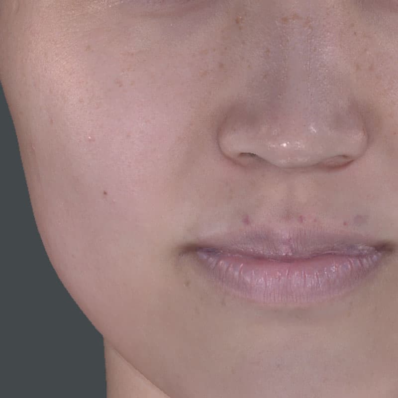 20251122_St20251122-3_fukuda_micro botox①Before