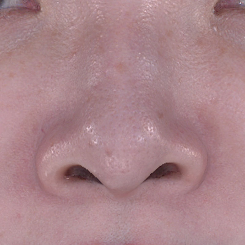 20251122_St20251122-5_fukuda_micro botox①After